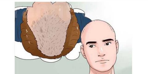 راقبت های بعد از کاشت مو