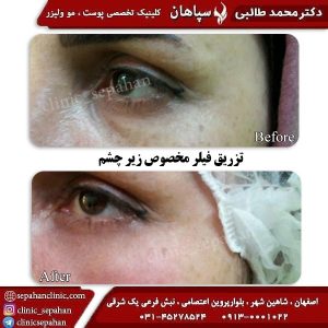 تزریق-فیلر-زیر-چشم-اصفهان