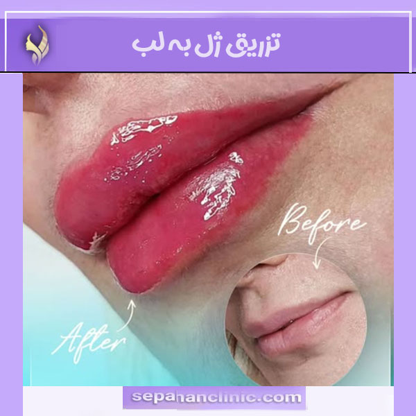 تزریق زل به لب _ کلینیک سپاهان