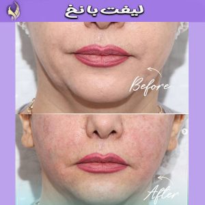 لیفت با نخ توسط دکتر محمد طالبی در اصفهان