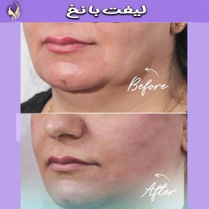 لیفت با نخ توسط دکتر محمد طالبی در اصفهان