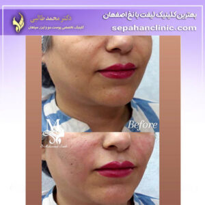 جوانسازی صورت با نخ