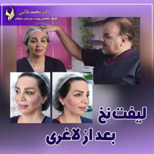 جوانسازی صورت با لیفت نخ