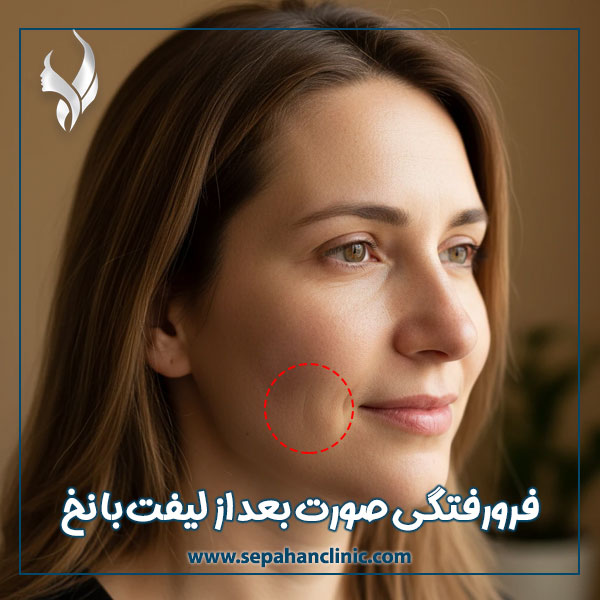 فرورفتگی صورت بعد از لیفت با نخ + کلینیک سپاهان