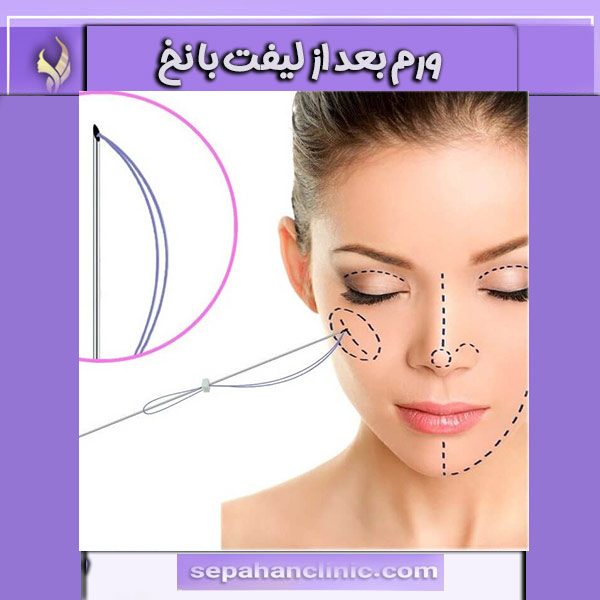 تورم بعد از لیفت با نخ _ کلینیک سپاهان