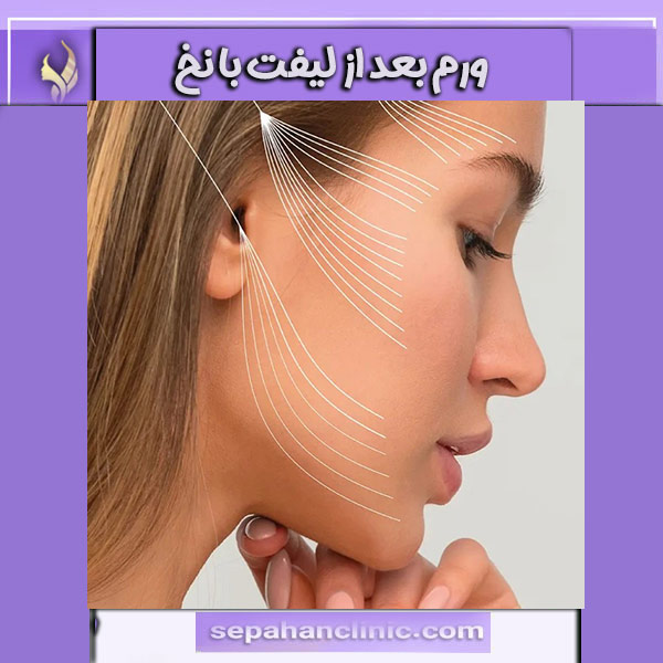 علت ورم بعد از لیفت با نخ _ کلینیک سپاهان