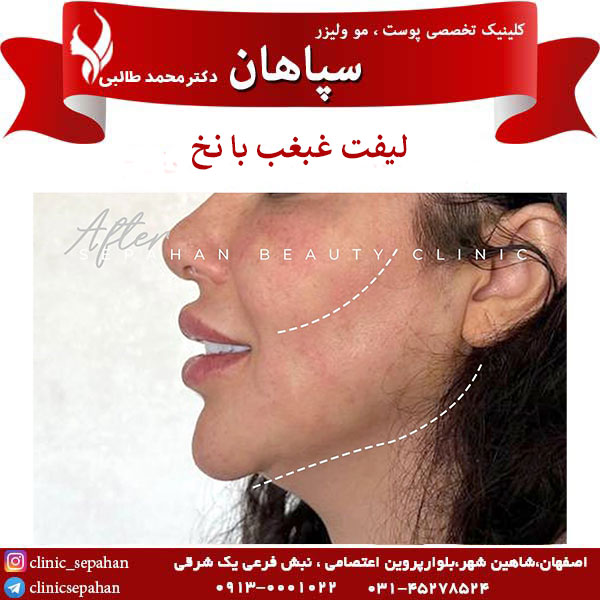 لیفت غبغب با نخ در اصفهان _ کلینیک سپاهان