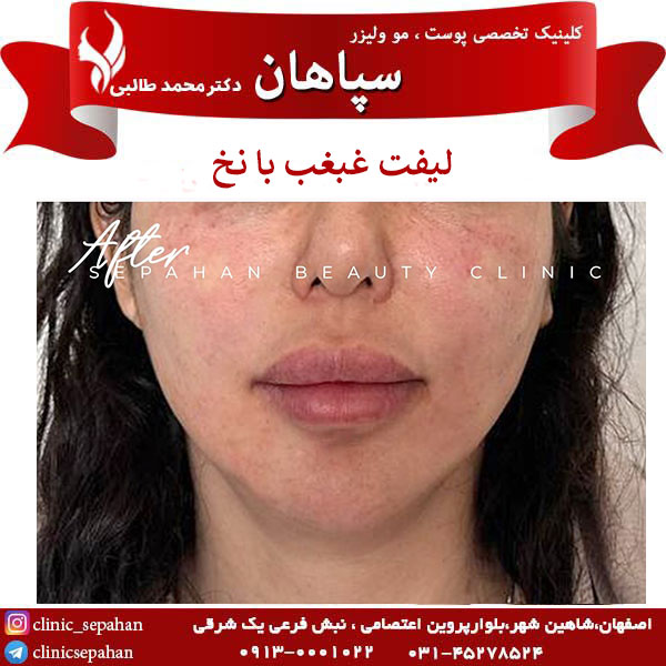 نمونه کار لیفت غبغب با نخ در اصفهان _ کلینیک سپاهان