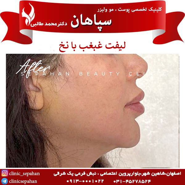 لیفت غبغب با نخ در اصفهان _ کلینیک سپاهان