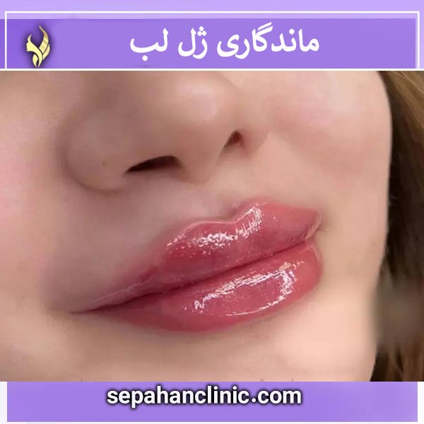 ماندگاری ژل لب _ کلینیک سپاهان