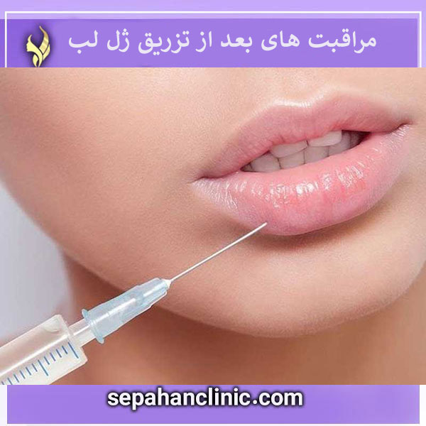 مراقبت های بعد از تزریق ژل لب _ کلینیک سپاهان