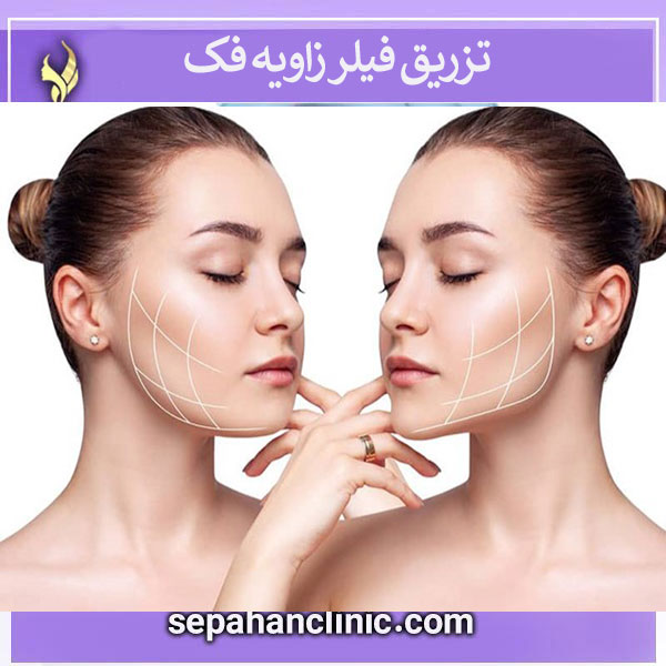 تزریق فیلر زاویه فک _ کلینیک سپاهان