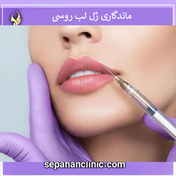 روش های افزایش ماندگاری ژل لب روسی _ کلینیک سپاهان