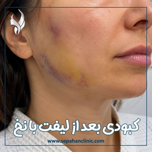  کبودی بعد از لیفت با نخ  + کلینیک سپاهان در اصفهان